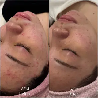 毛穴レス ハーブ& ワックス脱毛×光脱毛のエステ・リラクイメージ