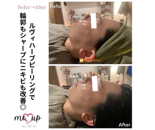 Meupニキビ専門店 背中/ハーブ/肌管理のその他イメージ