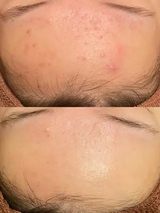 🔥3か月で肌革命 🔥ニキビ専門店のエステ・リラクイメージ