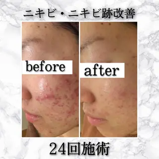 ショート カラー パーマ ヘアアレンジ メンズ キッズ ネイル マツエク・マツパ アイブロウ 夏までに肌荒れ卒業 するサロン🌻のエステ・リラクイメージ