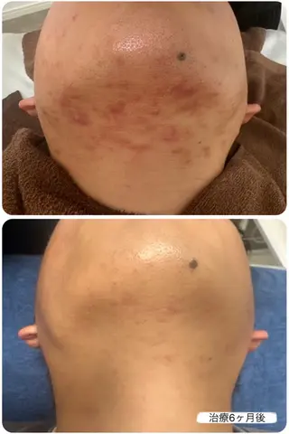 【赤ニキビ改善】 BELL'ET新宿店のエステ・リラクイメージ