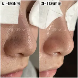 毛穴改善/脱毛 ネイル 川上久仁子のエステ・リラクイメージ