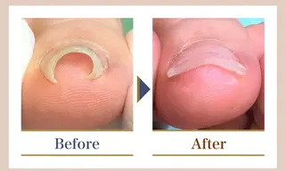 ネイル 巻き爪補正店越谷店所属・巻き爪補正店 越谷店のネイルデザイン