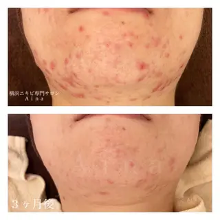 セミロング カラー パーマ ヘアアレンジ メンズ キッズ ネイル マツエク・マツパ ニキビ跡専門サロン Ainaのエステ・リラクイメージ