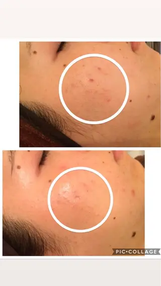 ニキビ/肌質改善専門 Snow skinのエステ・リラクイメージ