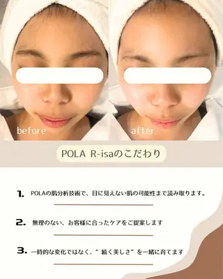 韓国/ピーリング 毛穴洗浄/POLAのエステ・リラクイメージ