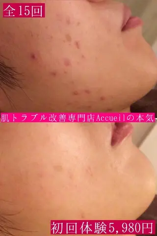 都内で出来る肌管理！ 最短ニキビ改善のエステ・リラクイメージ