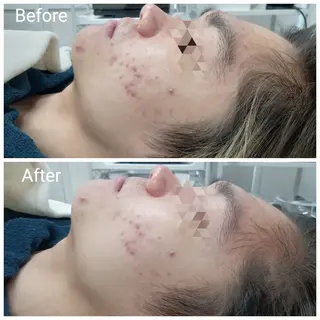 メンズ 肌質改善Beauty salon Renのエステ・リラクイメージ