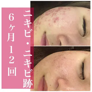 ミディアム パーマ ヘアアレンジ メンズ ネイル マツエク・マツパ アイブロウ ニキビ・肌質改善専門 ♡人生が変わるサロンのエステ・リラクイメージ