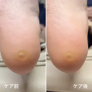 ネイル 深爪・巻き爪 専門サンセリテのネイルデザイン