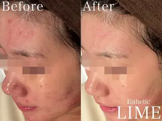 ハーブピーリング LIME池袋東口のエステ・リラクイメージ