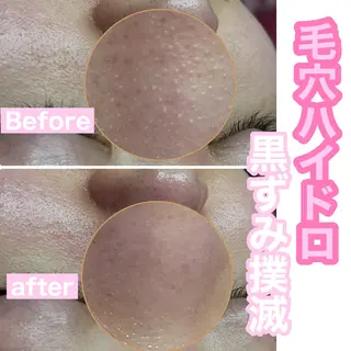 Chalon所属・REVI取扱・肌悩み 毛穴Chalonのエステ・リラクイメージ