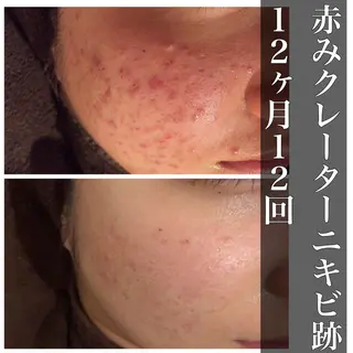 🔥3か月で肌革命 🔥ニキビ専門店のエステ・リラクイメージ