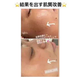 アロマ•ピーリング SalonYokoのその他イメージ