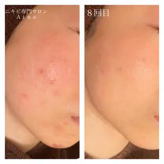 ロング カラー パーマ ヘアアレンジ メンズ キッズ ネイル マツエク・マツパ ニキビ跡専門サロン Ainaのエステ・リラクイメージ