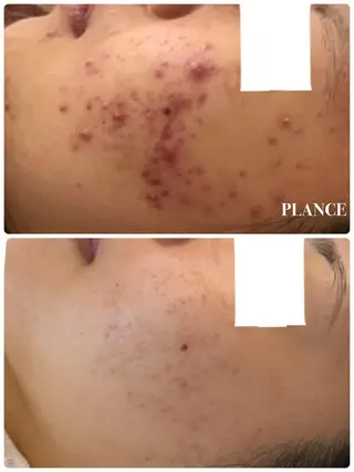 フェイシャル専門 肌質改善/プランスのエステ・リラクイメージ