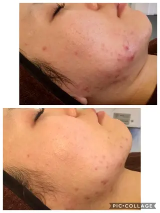 ニキビ/肌質改善専門 Snow skinのエステ・リラクイメージ