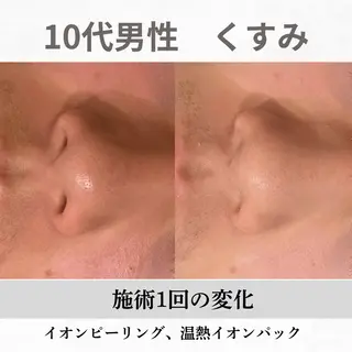 重度ニキビ専門🌷 ダウンタイムなしのエステ・リラクイメージ