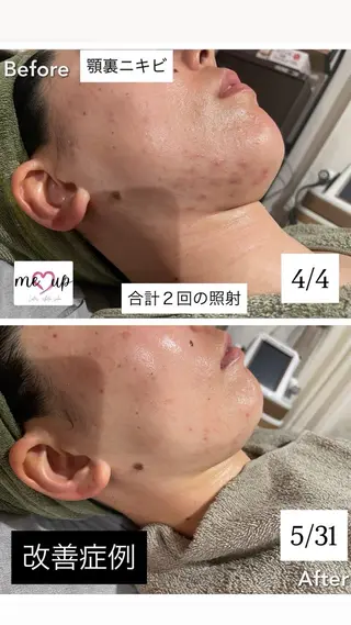 Meupニキビ専門店 背中/ハーブ/肌管理のその他イメージ