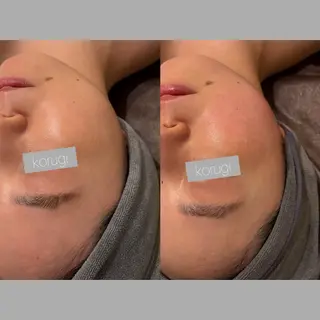 ☆痩身/小顔☆ ハイパーナイフexのエステ・リラクイメージ