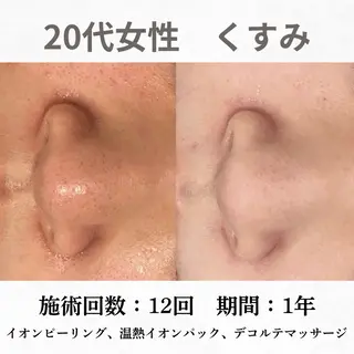 重度ニキビ専門🌷 ダウンタイムなしのエステ・リラクイメージ