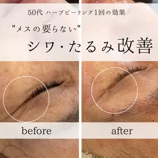 yc.hacci 【ハーブピーリング】のエステ・リラクイメージ