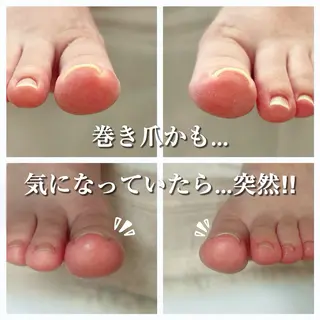 巻き爪フットケアサロンKotori所属・フットケアサロン Kotoriのその他イメージ