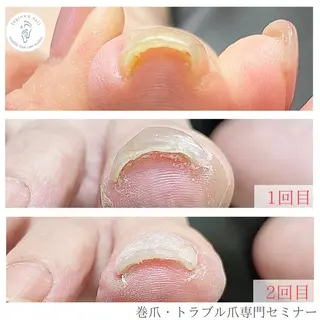 ネイル 深爪・巻き爪 専門サンセリテのネイルデザイン