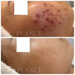 フェイシャル専門 肌質改善/プランスのエステ・リラクイメージ