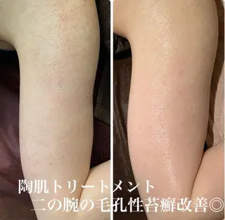 ハーブピーリング/韓国肌管理/フェイシャル/毛穴洗浄/眉毛/顔脱毛【糸脱毛専門】rev所属・ハーブピーリング🌹 毛穴洗浄❤️眉waxのエステ・リラクイメージ