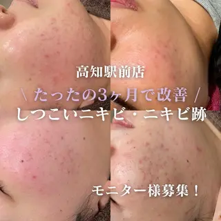 脱毛・ニキビ毛穴ケア HIMEKAのエステ・リラクイメージ