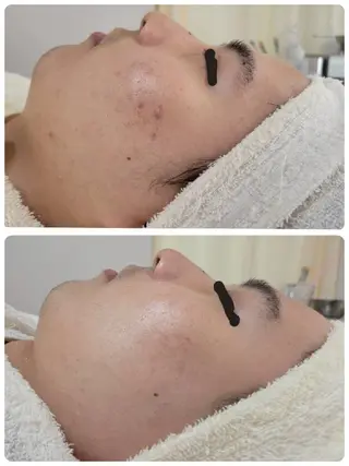 〈ニキビケアサロン〉 レゾン京橋店/ 浅川のエステ・リラクイメージ