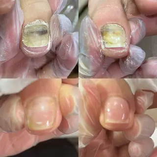 ネイル 自爪育成・巻き爪 補正講師　津蔵のネイルデザイン