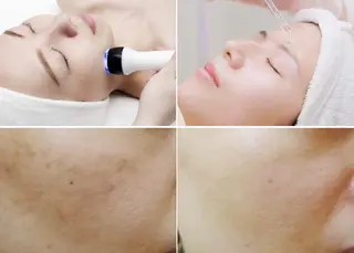 顔脱毛＆毛穴＆ニキビ 優良№1♪ヒロコ♪のエステ・リラクイメージ