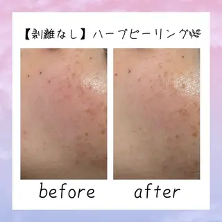 ニキビ改善シャルム ココハーブピーリングのエステ・リラクイメージ