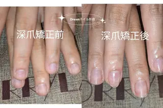 ネイル ネイリストゆか💅 長さだし、深爪矯正のネイルデザイン
