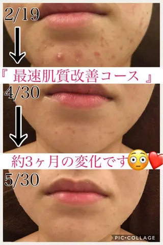 ミディアム カラー パーマ ヘアアレンジ メンズ キッズ ネイル マツエク・マツパ ニキビ・肌質改善専門 ♡人生が変わるサロンのエステ・リラクイメージ