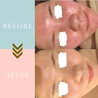 ニキビケア/毛穴/ 赤み/自信の肌✨森園のエステ・リラクイメージ