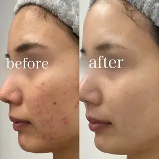 REVIハーブピーリング/バストケア/脱毛 Retea.【ルテア】所属・ハーブピーリング| 毛穴洗浄|ルテアのエステ・リラクイメージ