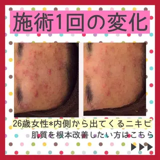 ミディアム カラー パーマ ヘアアレンジ メンズ キッズ ネイル マツエク・マツパ アイブロウ ニキビ・肌質改善専門 ♡人生が変わるサロンのエステ・リラクイメージ