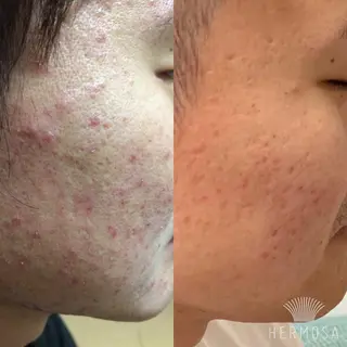 【ニキビ/肌管理】 salon varyのエステ・リラクイメージ