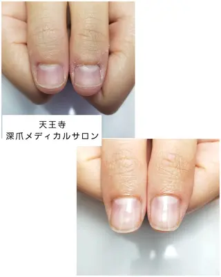 ネイル 天王寺 深爪メディカルサロンのネイルデザイン