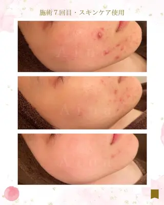 ニキビ跡専門サロン Ａｉｎａのエステ・リラクイメージ