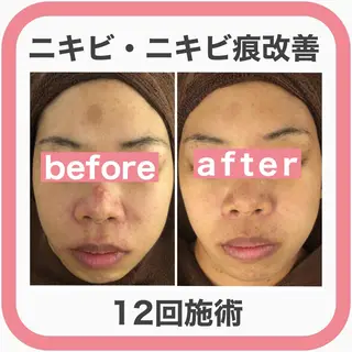 メンズ マツエク・マツパ アイブロウ ニキビ・肌質改善専門 ♡人生が変わるサロンのエステ・リラクイメージ