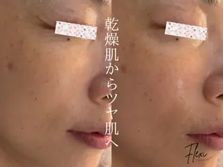 Flexi 表参道所属・🌟ニキビ・毛穴ケア 🌿Flexi表参道のエステ・リラクイメージ