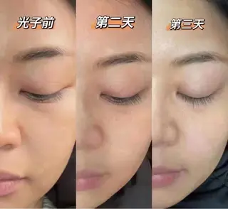 ネイル aliaハイフ&水光ジェットサロン所属・aliaハーブ水光店 エステティシャン募集のエステ・リラクイメージ