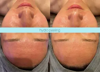 ☆痩身/小顔☆ ハイパーナイフexのエステ・リラクイメージ