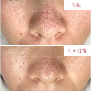 毛穴ケア専門サロンアンスリウム所属・茨城土浦 つくば毛穴 ケア専門サロンのエステ・リラクイメージ