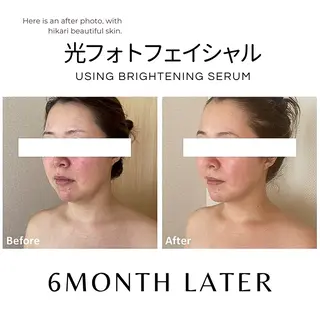 脱毛サロン　HUGME.所属・脱毛サロンHUGME 光フォトフェイシャルのエステ・リラクイメージ