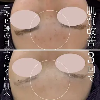 yukiko/中崎町 肌質改善/éclaのエステ・リラクイメージ